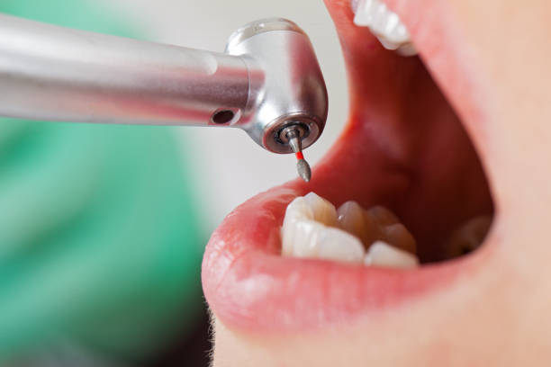 Best Emergency Dentist for Lost Fillings or Crowns in Brownsville, TX